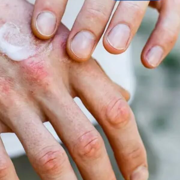 Biểu hiện của dị ứng với formaldehit _2