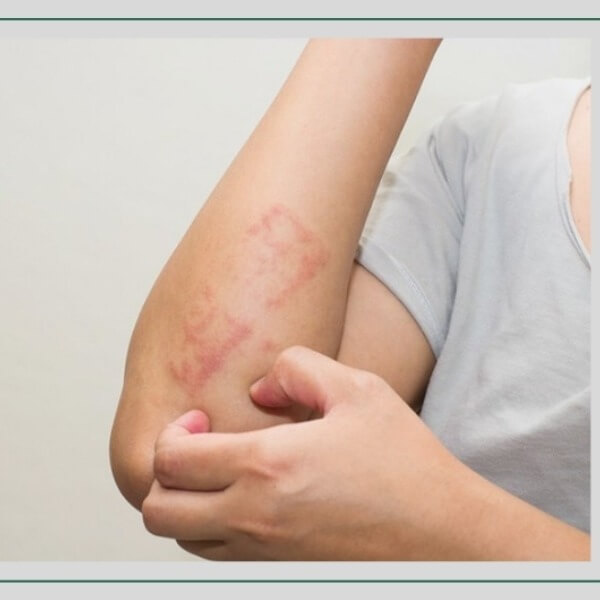 Formaldehit trong không khí ảnh hưởng sức khỏe như thế nào_2