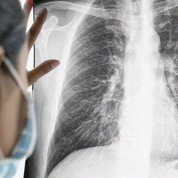 Phương pháp chẩn đoán và điều trị bệnh viêm phổi cấp_4