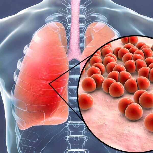 Viêm phổi cấp có triệu chứng như thế nào_5