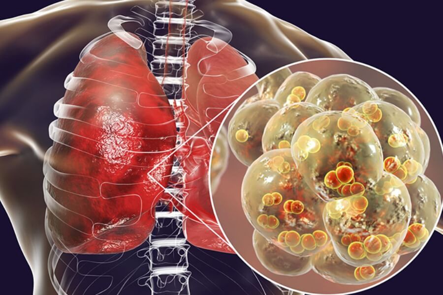 Viêm phổi cấp là gì Triệu chứng và cách điều trị_1