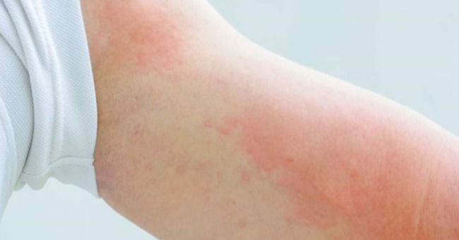 Dị ứng thời tiết Nguyên nhân, biểu hiện và cách chữa trị, phòng ngừa_1