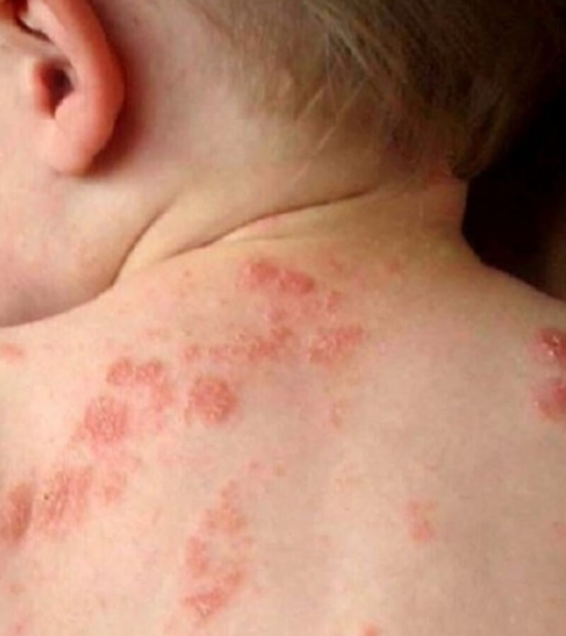 Dị ứng thời tiết có nguy hiểm không_3