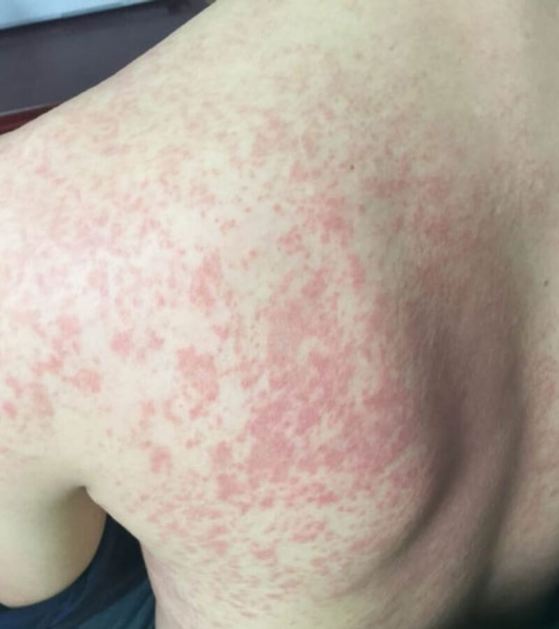 Nguyên nhân bệnh dị ứng thời tiết_4