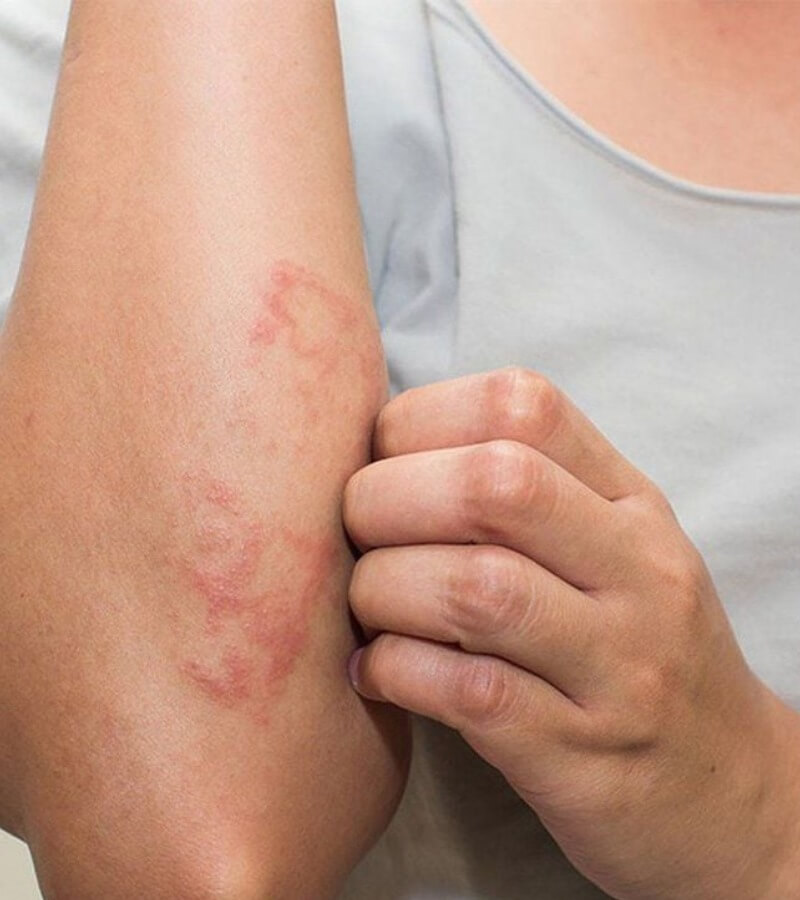 Thuốc lá gây ra viêm da tiếp xúc_4