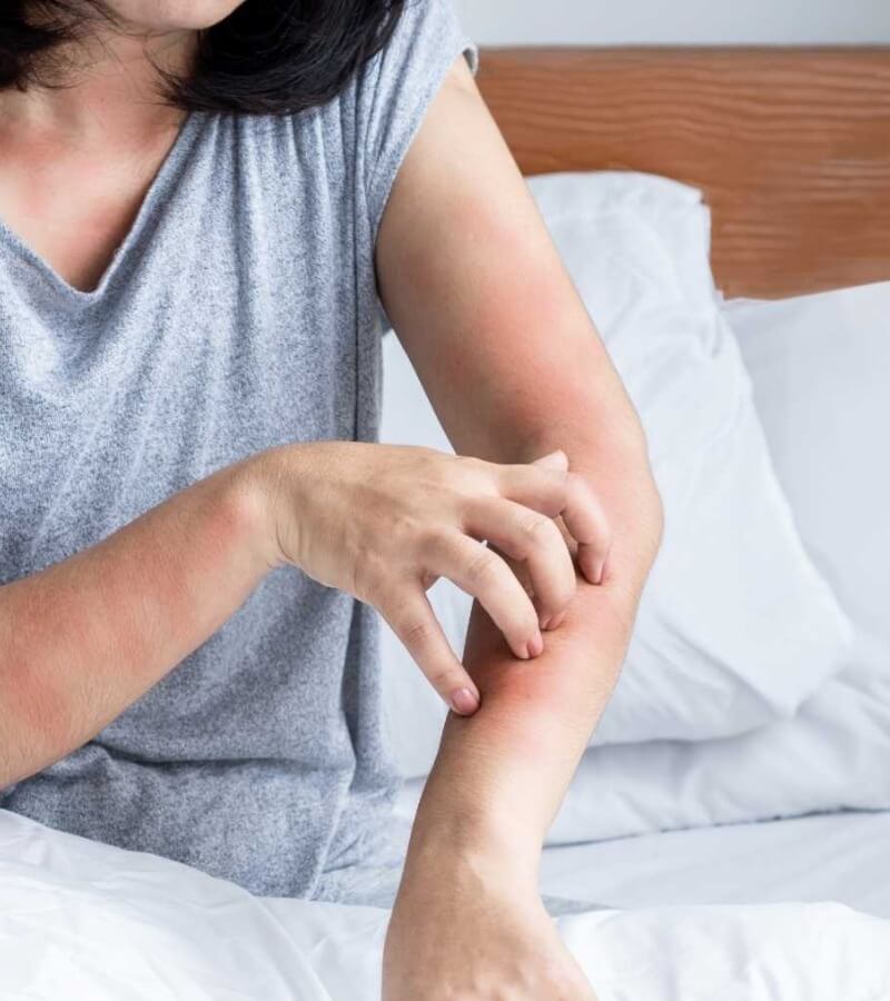Các dấu hiệu mạt bụi nhà gây ngứa thường gặp_2
