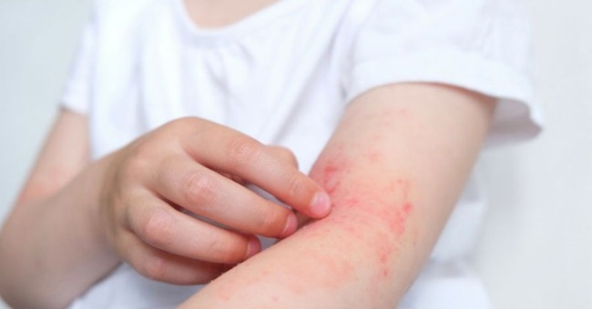 Các dấu hiệu mạt bụi nhà gây ngứa và giải pháp hiệu quả_1