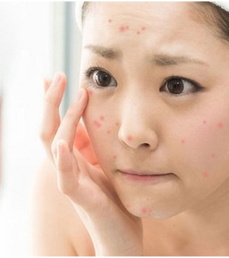 Cách xử lý khi da mặt bị dị ứng bụi vải, bụi bẩn_3