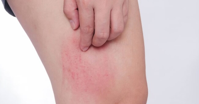 Dị ứng bụi nổi mề đay có nguy hiểm không Cách phòng ngừa hiệu quả_1