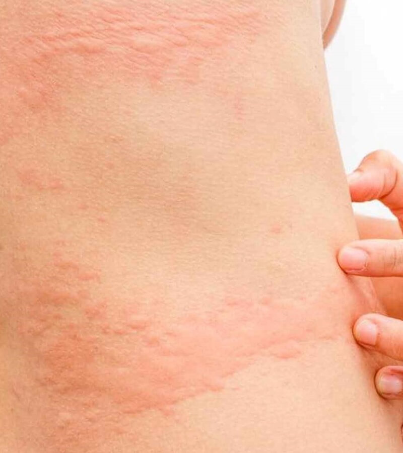 Dị ứng bụi nổi mề đay có nguy hiểm không_3