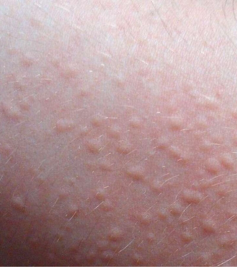 Dị ứng bụi nổi mề đay là gì_ Vì sao có thể xảy ra_4