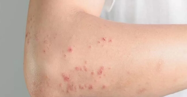 Dị ứng bụi nổi mụn là gì, nguyên nhân và cách bảo vệ sức khỏe gia đình_1