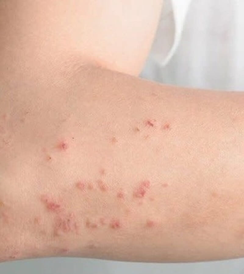 Dị ứng mạt bụi nhà có điều trị khỏi hoàn toàn được không_2