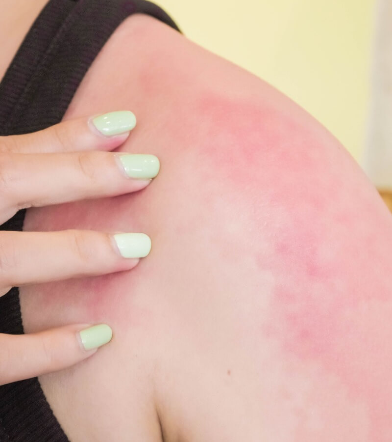 Triệu chứng của da mặt, mũi bị dị ứng bụi vải, bụi bẩn_4